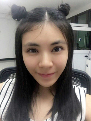 青海康華馬晶醫(yī)生切開(kāi)雙眼皮真實(shí)案例分享