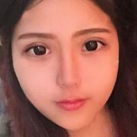 切開雙眼皮+開眼角前后對比圖和恢復過程分享