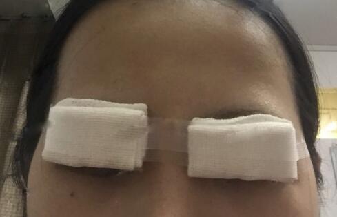 切開(kāi)雙眼皮+開(kāi)眼角前后對(duì)比圖和恢復(fù)過(guò)程分享