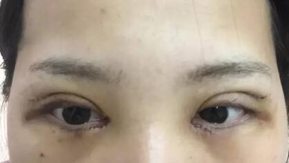切開(kāi)雙眼皮+開(kāi)眼角前后對(duì)比圖和恢復(fù)過(guò)程分享
