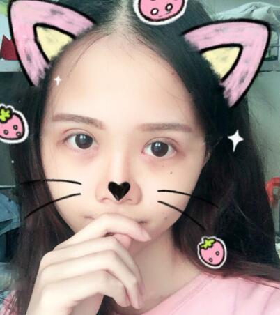 切開(kāi)雙眼皮+開(kāi)眼角前后對(duì)比圖和恢復(fù)過(guò)程分享