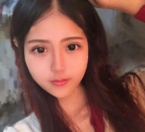 切開(kāi)雙眼皮+開(kāi)眼角前后對(duì)比圖和恢復(fù)過(guò)程分享