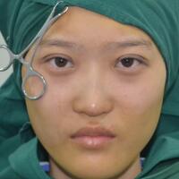 切開雙眼皮多少錢？割雙眼皮真實案例多對比圖分享