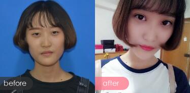 切開(kāi)雙眼皮多少錢(qián)?割雙眼皮真實(shí)案例多對(duì)比圖分享