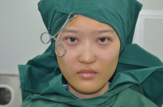 切開(kāi)雙眼皮多少錢(qián)?割雙眼皮真實(shí)案例多對(duì)比圖分享