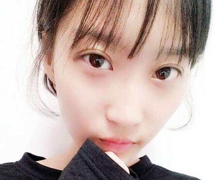 切開(kāi)雙眼皮多少錢(qián)?割雙眼皮真實(shí)案例多對(duì)比圖分享