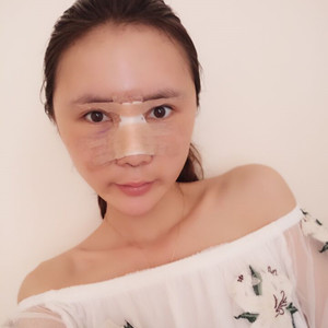 濟南海峽趙廣生做的自體耳軟骨墊鼻尖+硅膠隆鼻前后對比照片分享