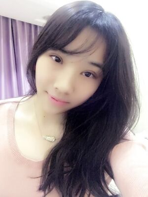 洛陽(yáng)孔繁榮切開雙眼皮+開眼角手術(shù)恢復(fù)過(guò)程圖