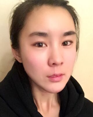 自體脂肪面部填充三個月果圖分享，減齡十歲