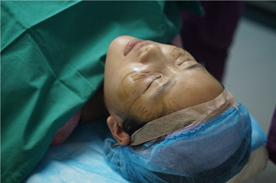 自體脂肪豐蘋(píng)果肌前后手術(shù)過(guò)程和對(duì)比照片分享，濟(jì)南愛(ài)容張慶國(guó)醫(yī)生做的