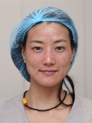 濟(jì)南愛容路傳燕醫(yī)生做的激光去黃褐斑，大家快來看看果如何