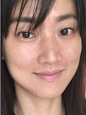 濟(jì)南愛容路傳燕醫(yī)生做的激光去黃褐斑，大家快來看看果如何