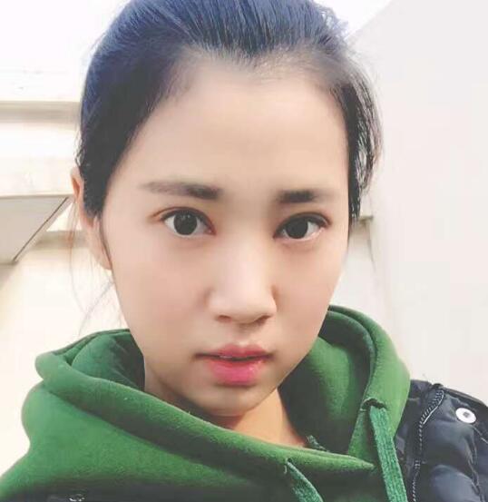 開眼角+割雙眼皮真實(shí)案例前后對(duì)比圖分享——四川悅好整形