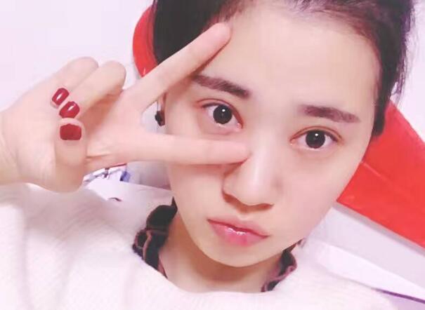 開眼角+割雙眼皮真實(shí)案例前后對(duì)比圖分享——四川悅好整形