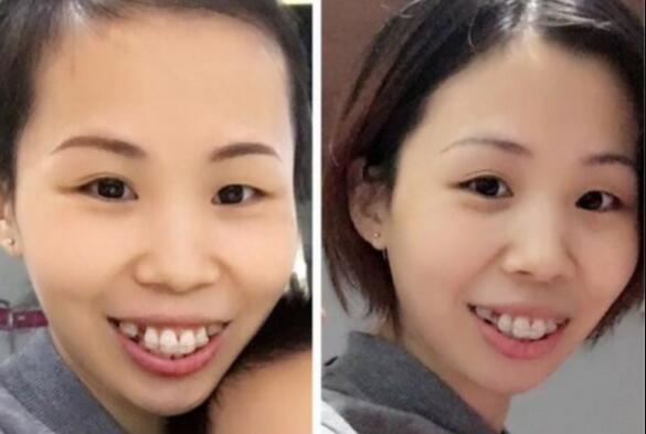 牙齒矯正的很好的年齡，多對比圖真實(shí)案例分享——成都格林口腔