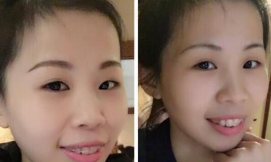 牙齒矯正的很好的年齡，多對比圖真實(shí)案例分享——成都格林口腔