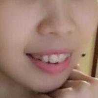 牙齒矯正的適宜年齡，多對比圖真實案例分享——成都格林口