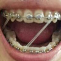 成人牙齒矯正費用9800元——成都格林口腔醫(yī)院