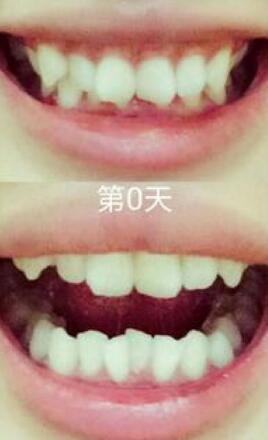 成人牙齒矯正費用9800元——成都格林口腔醫(yī)院