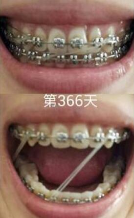牙齒矯正前后對比圖，成人牙齒矯正費用9800元——成都格林口腔醫(yī)院