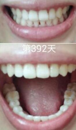 牙齒矯正前后對比圖，成人牙齒矯正費用9800元——成都格林口腔醫(yī)院