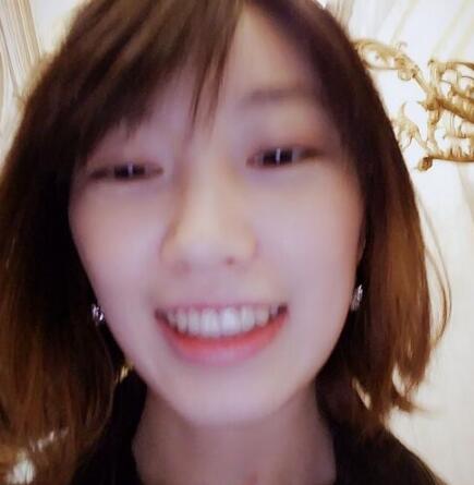 牙齒矯正前后對比圖，成人牙齒矯正費用9800元——成都格林口腔醫(yī)院