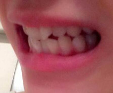 成都矯正牙齒案例分享——成都格林口腔醫(yī)院