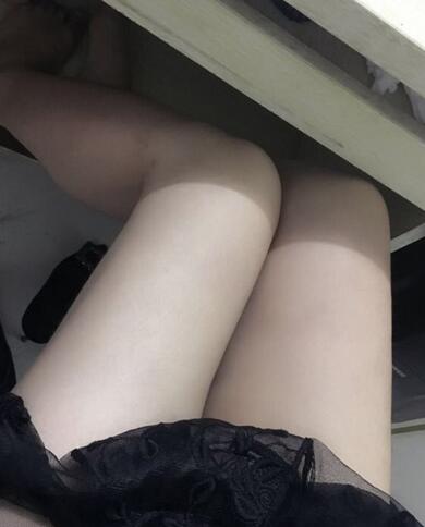 上海九院曹衛(wèi)剛大腿抽脂后恢復(fù)圖