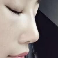 假體隆鼻恢復(fù)時間2個月真實案例分享——成都魅麗經(jīng)緯