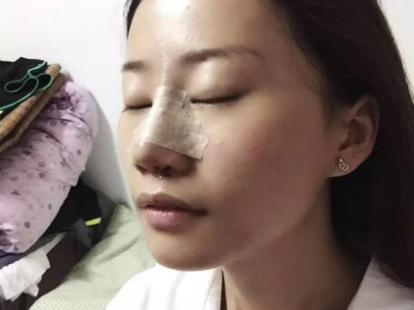 假體隆鼻前后對比圖，假體隆鼻恢復(fù)時(shí)間2個(gè)月真實(shí)案例