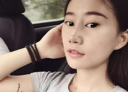 假體隆鼻前后對比圖，假體隆鼻恢復(fù)時(shí)間2個(gè)月真實(shí)案例