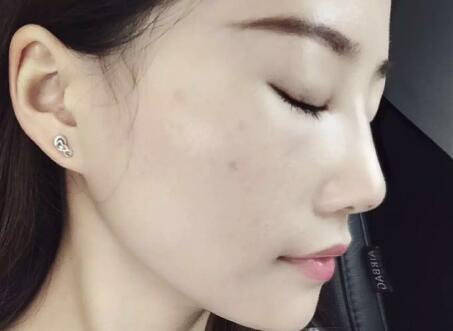 假體隆鼻前后對比圖，假體隆鼻恢復(fù)時(shí)間2個(gè)月真實(shí)案例