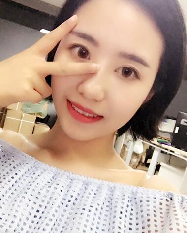 武漢憶美凱德去眼袋手術(shù)后兩個月照片