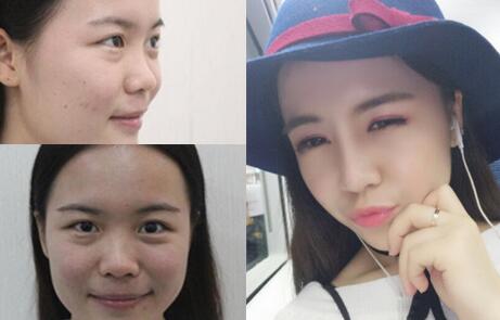 隆鼻整形前后對(duì)比圖，歪鼻子矯正整形恢復(fù)過(guò)程