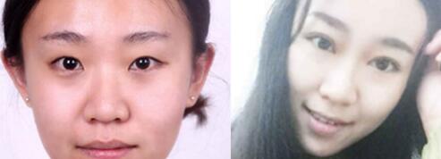 雙眼皮切割前后對(duì)比圖，單眼皮變雙眼皮整形恢復(fù)過程