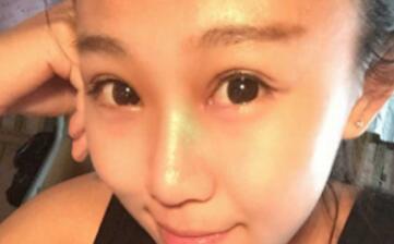 單眼皮變雙眼皮整形恢復(fù)過程和對(duì)比圖