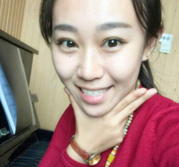 單眼皮變雙眼皮整形恢復(fù)過程和對(duì)比圖