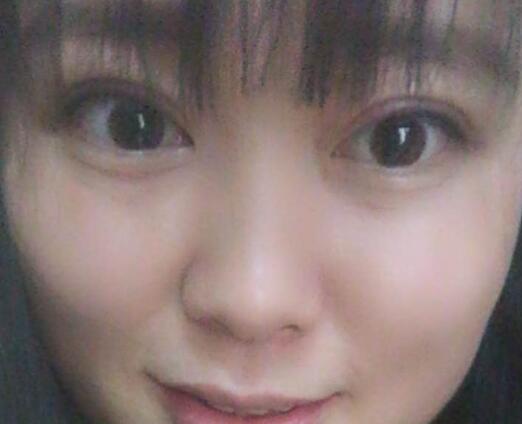 割雙眼皮前后對比圖和恢復(fù)過程