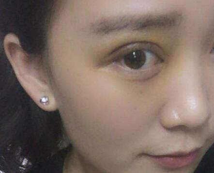 割雙眼皮前后對比圖和恢復(fù)過程