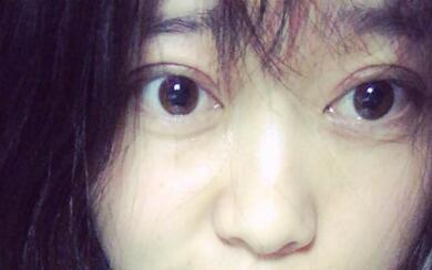 割雙眼皮前后對比圖和恢復(fù)過程