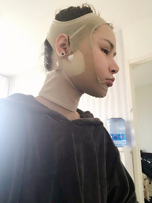 深圳南西子鄭舉衛(wèi)做的吸脂瘦臉，讓我基本擺脫嬰兒肥了