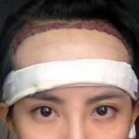 種頭發(fā)有用嗎？種植頭發(fā)恢復(fù)過程真實(shí)案例——南京明基醫(yī)院