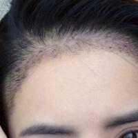 種頭發(fā)有用嗎？種植頭發(fā)恢復(fù)過程真實(shí)案例——南京明基醫(yī)院
