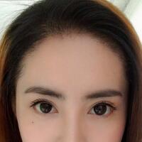 種頭發(fā)有用嗎？種植頭發(fā)恢復(fù)過程真實(shí)案例——南京明基醫(yī)院