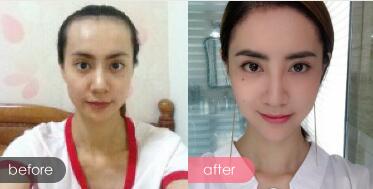 種頭發(fā)有用嗎？種植頭發(fā)恢復(fù)過程真實案例