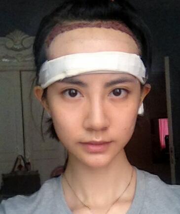 種頭發(fā)有用嗎？種植頭發(fā)恢復(fù)過程真實案例