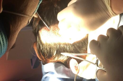 種頭發(fā)有用嗎？種植頭發(fā)恢復(fù)過程真實案例