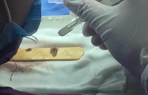 種頭發(fā)有用嗎？種植頭發(fā)恢復(fù)過程真實案例