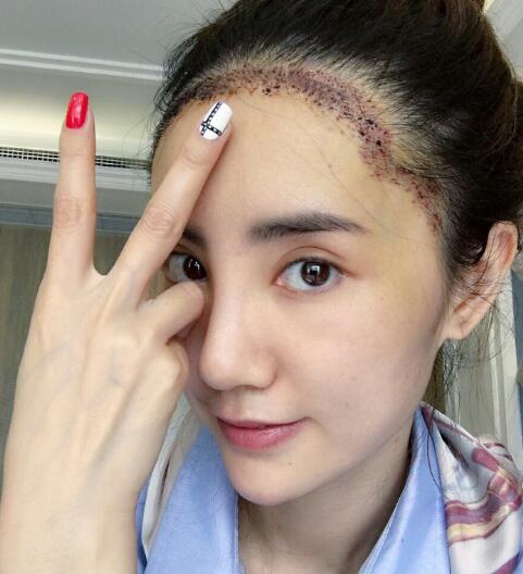 種頭發(fā)有用嗎？種植頭發(fā)恢復(fù)過程真實案例