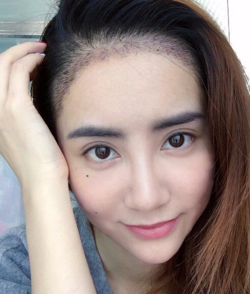 種頭發(fā)有用嗎？種植頭發(fā)恢復(fù)過程真實案例